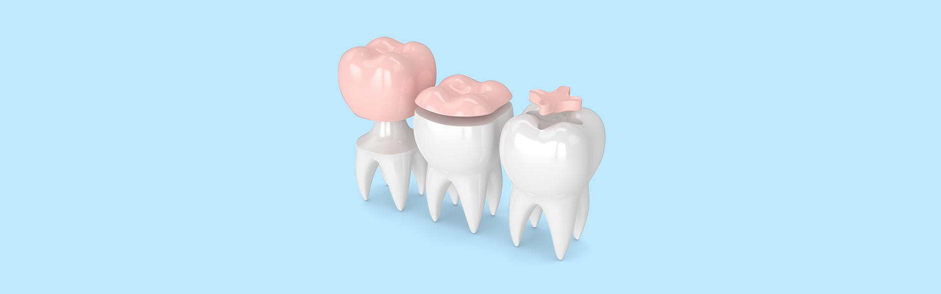 Dental-sealants